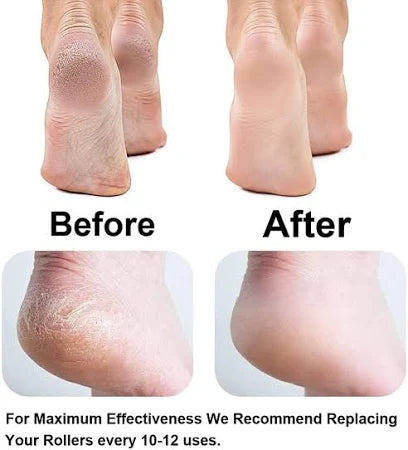 Rechargeable Callus Remover